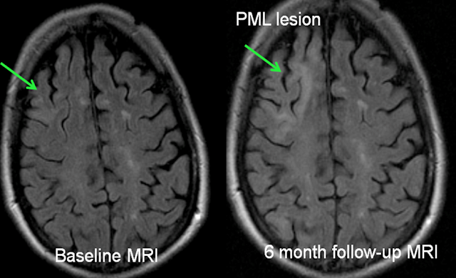 Clinic Speak: Asymptomatic PML – Prof G's MS Blog Archive